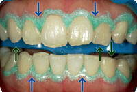 ホワイトニング薬剤の刺激から歯茎を守る保護剤