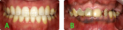 プラークコントロールは歯疾患予防の要