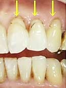 歯茎の虫歯治療 術前