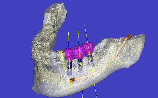 下顎に3本インプラントを埋入して、かぶせ物をした時のシミュレーション