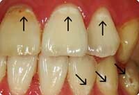 エナメル質の虫歯は脱灰して白濁を呈する