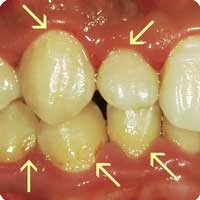 歯の付け根や歯間にプラーク（歯垢）の付着が多い