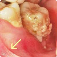 歯石、小帯異常などはリスクファクター