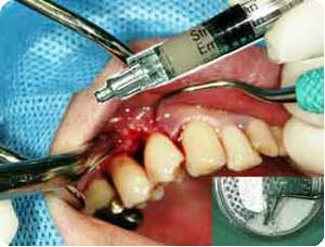 歯周組織再生療法の手術