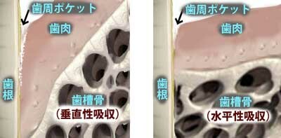歯槽骨の垂直性吸収が適応症