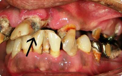 歯肉縁上から続く歯肉縁下歯石