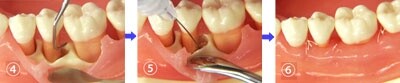 歯周組織再生剤塗布手順b