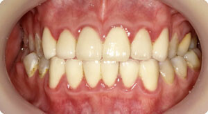 歯肉炎の特徴