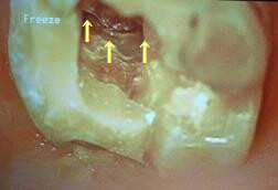 上顎の臼歯(うわあごのおくば)の根管口 (左写真)