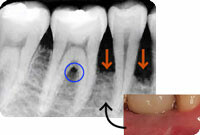 歯周病診断へのプロセス