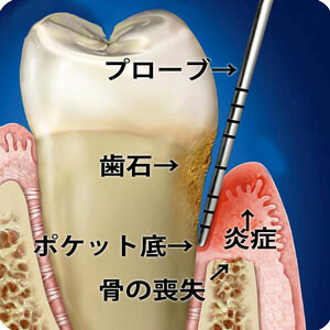 歯周病のポケット検査