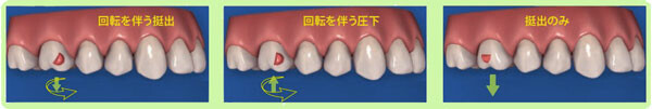 インビザラインG7の大臼歯最適アタッチメント