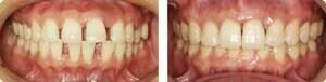 すきっ歯 (空隙歯列) の治療方法