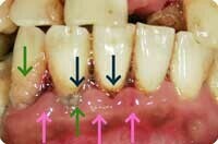 歯周基本治療でプラークや歯石を取り除きます